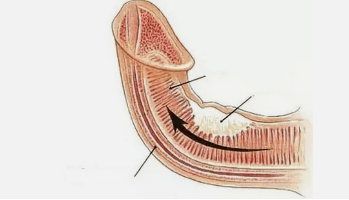 Eliminating venous drainage